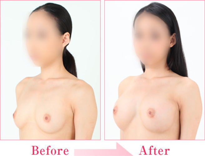 画像 騙されるな 豊胸おっぱいビフォーアフター術前 術後を比較してみた エロ画像ちゃぼらんぷ